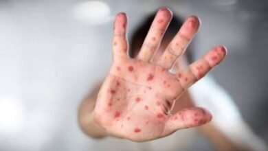 Key details about Mpox